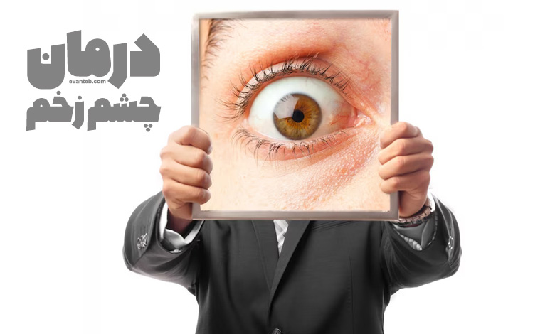 درمان چشم زخم در طب سنتی اسلامی (اصابت العین)