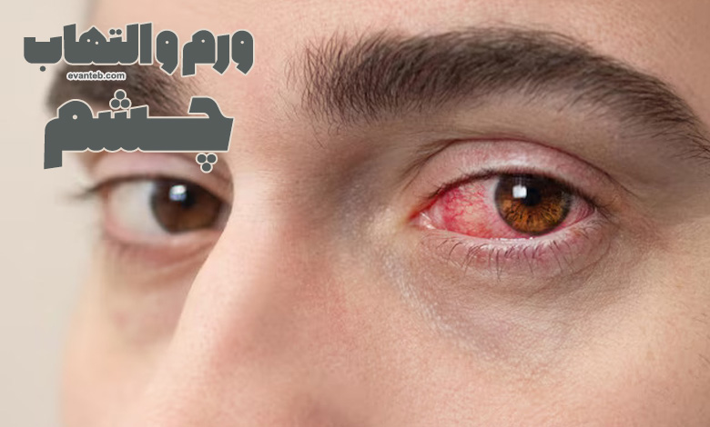 ورم چشم یا التهاب های چشمی